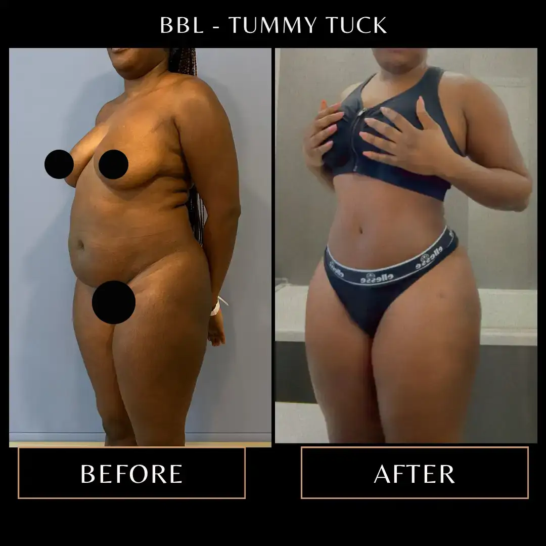 Abdominoplastia e BBL: antes e depois