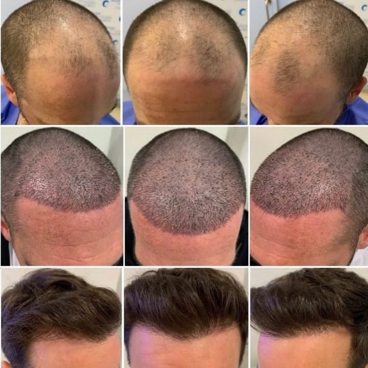 Transplante capilar: antes, logo depois e resultado final