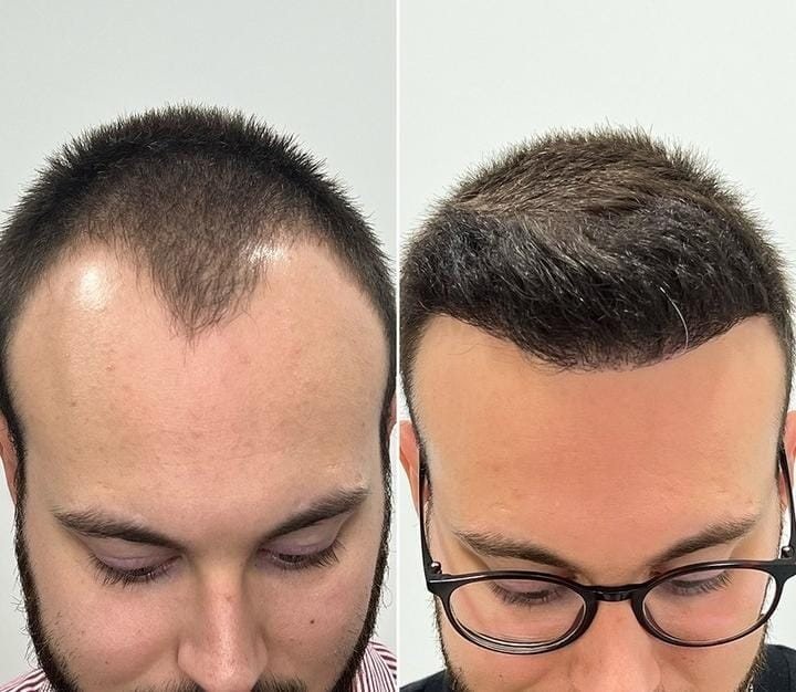 Transplante capilar: antes e depois na linha frontal