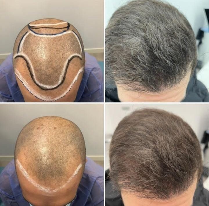 Transplante capilar: zona marcada e resultado