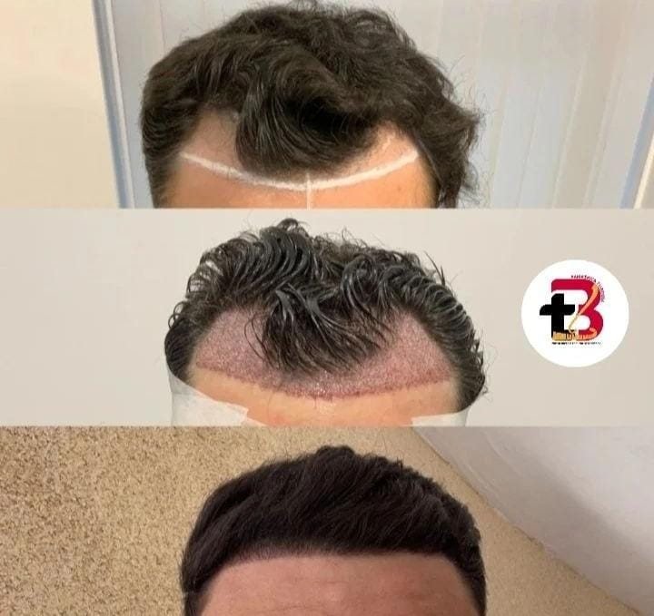 Transplante capilar: desenho da linha frontal e resultado