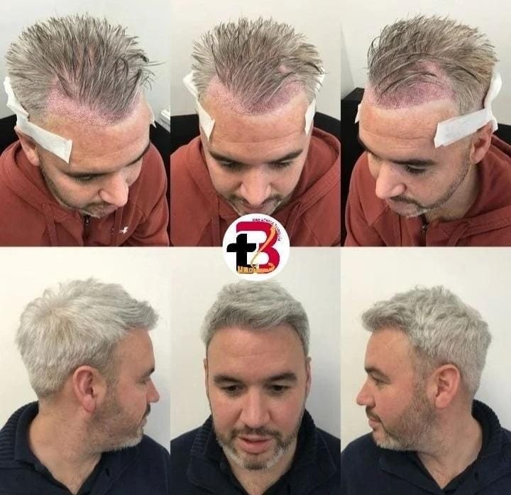 Transplante capilar: logo depois e resultado final