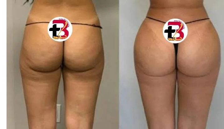 Glúteos antes e depois, vista de costas