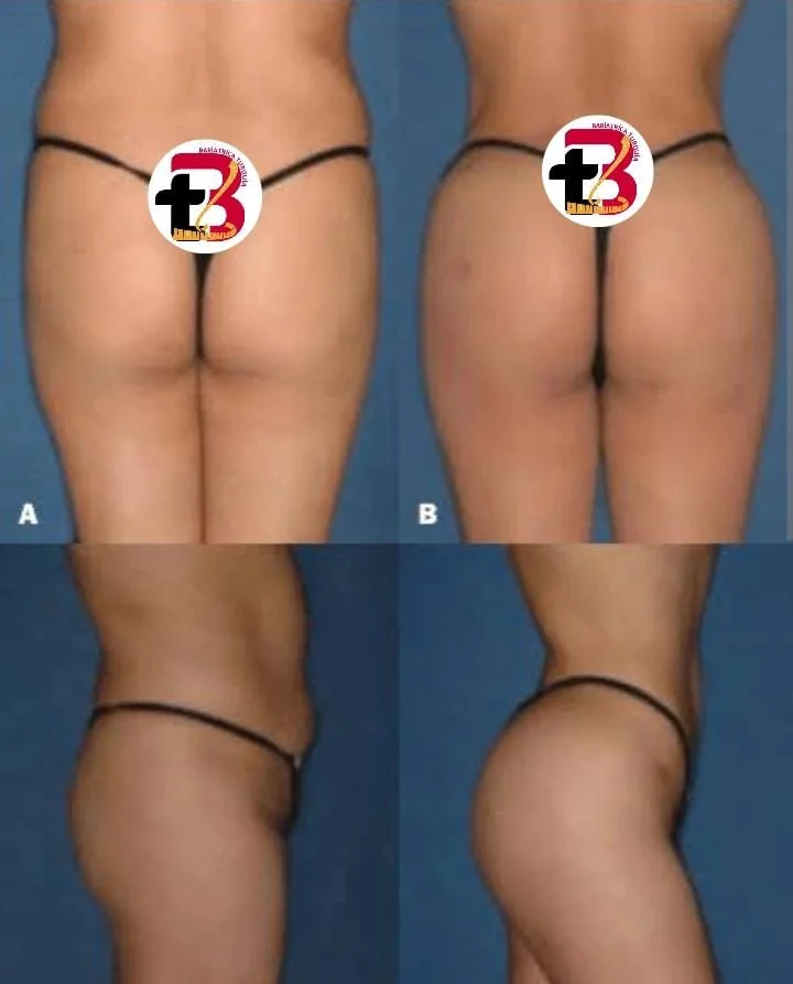 Glúteos antes e depois, de costas e de lado
