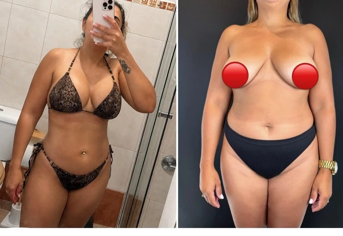 Paciente antes e depois da lipoaspiração, de frente
