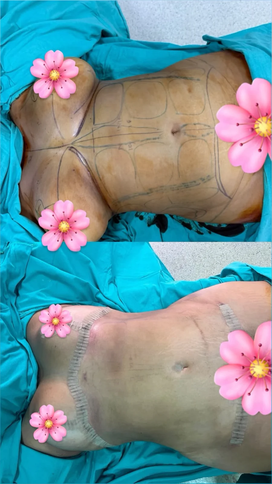 Costas antes e depois da lipoaspiração
