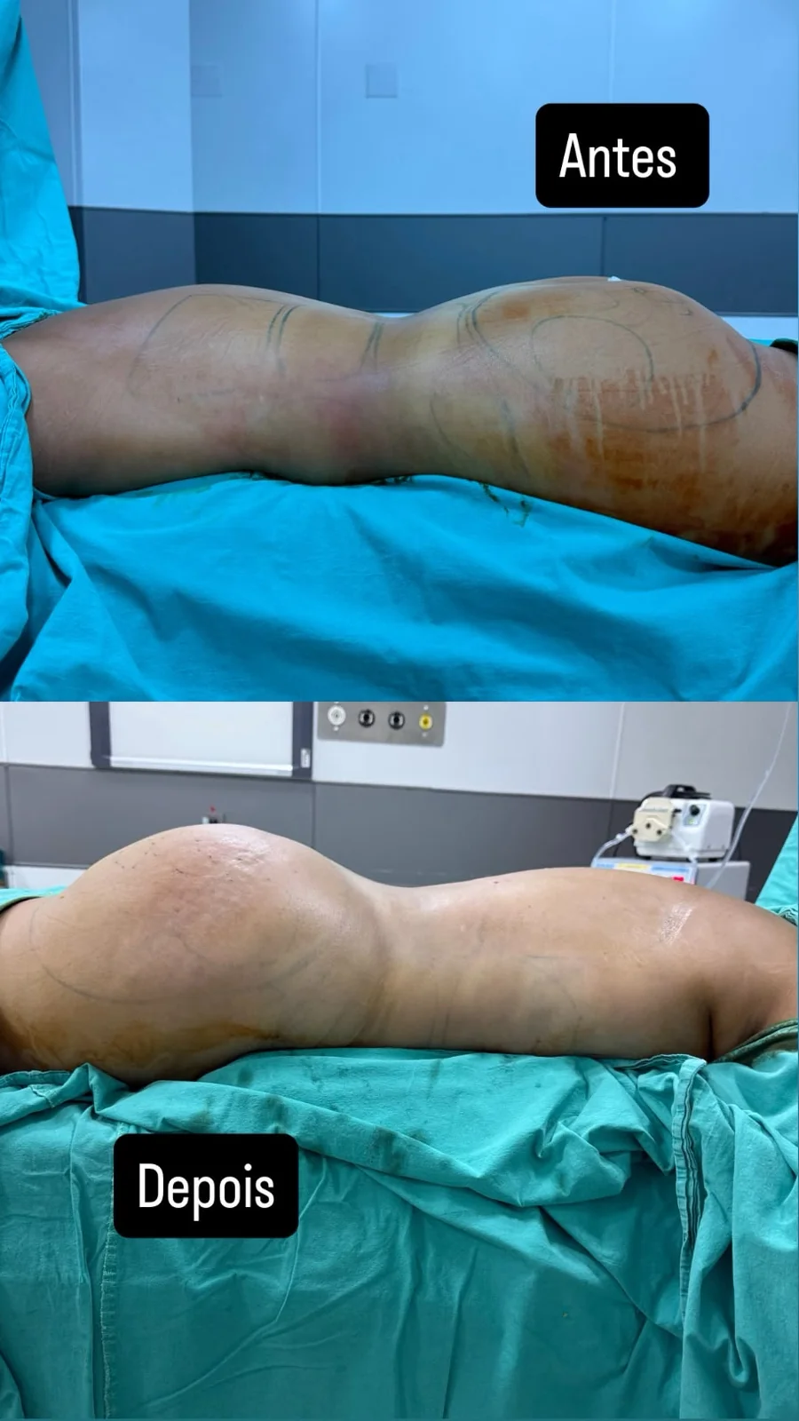 Contorno lateral antes e depois