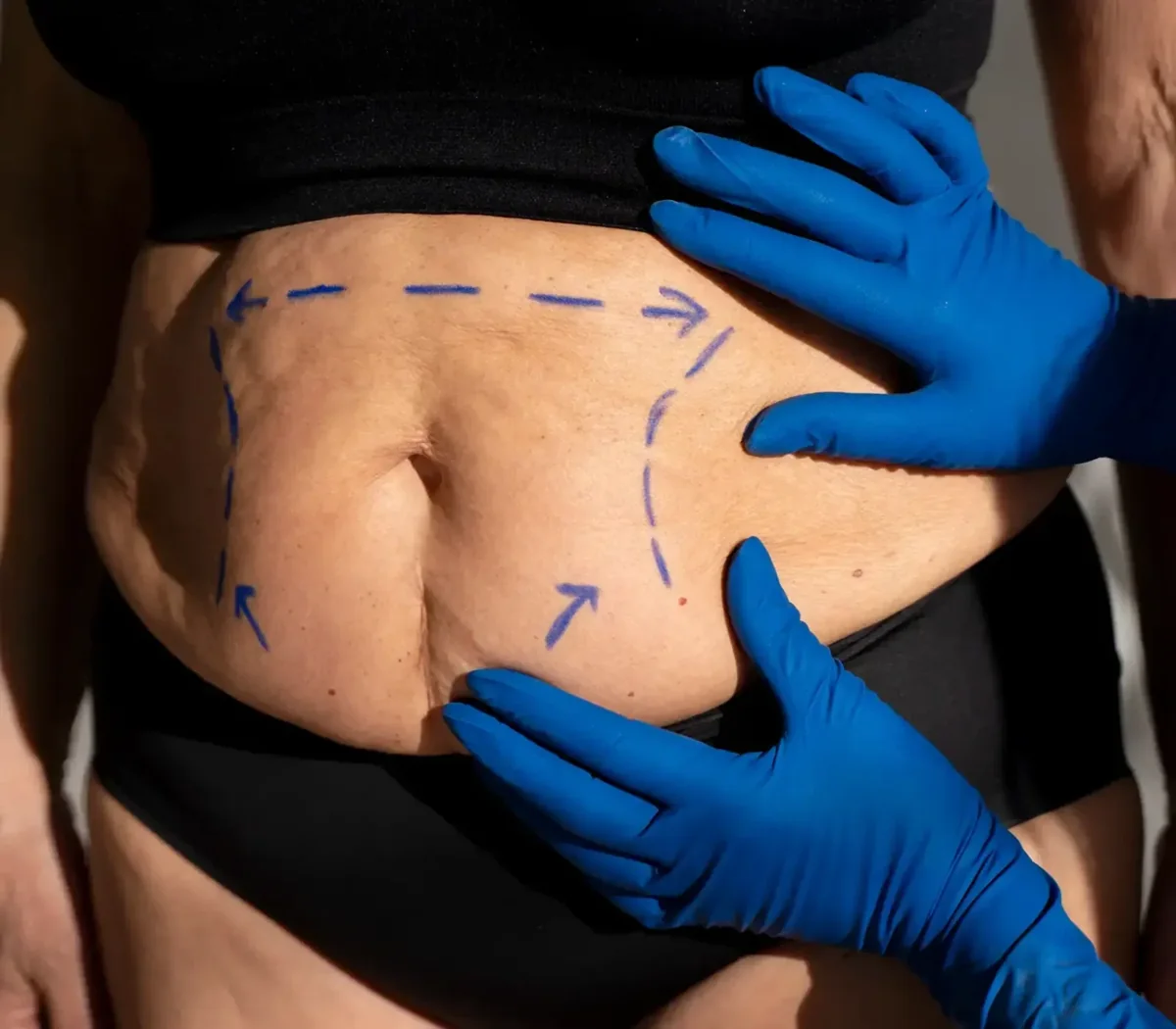 Marcação do abdómen antes da lipoaspiração