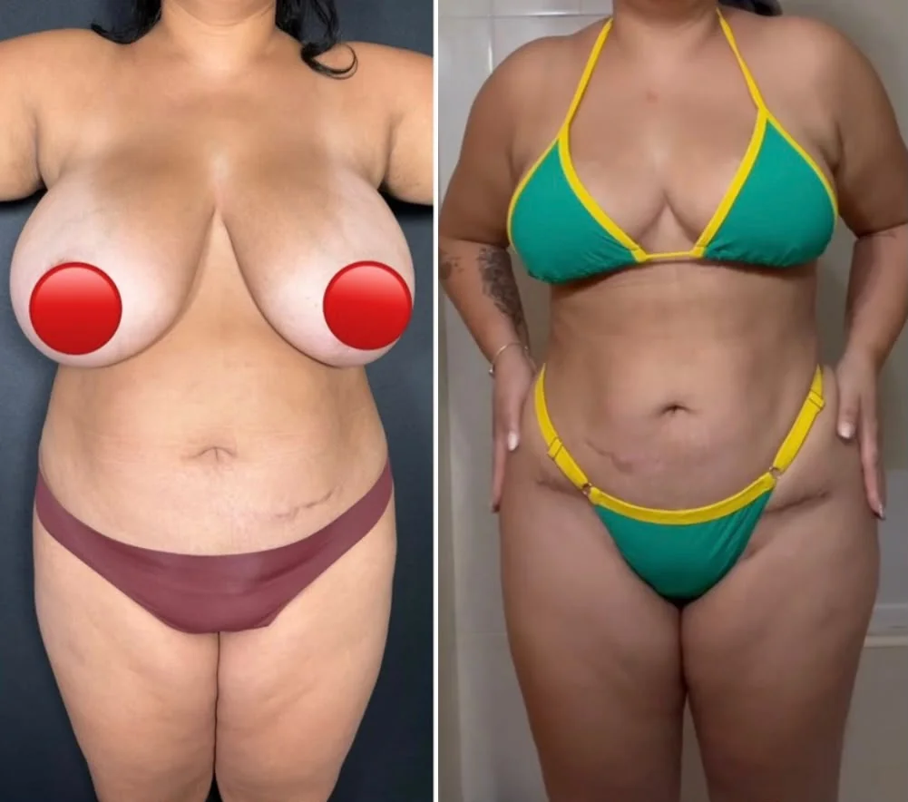 Mommy makeover: mama e abdómen antes e depois
