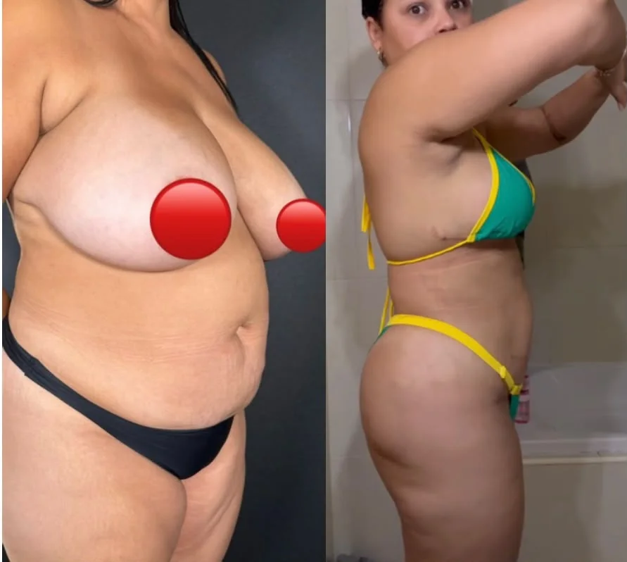 Mommy makeover: vista lateral antes e depois
