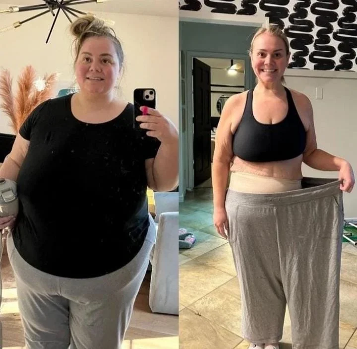 Paciente antes e depois da perda de peso