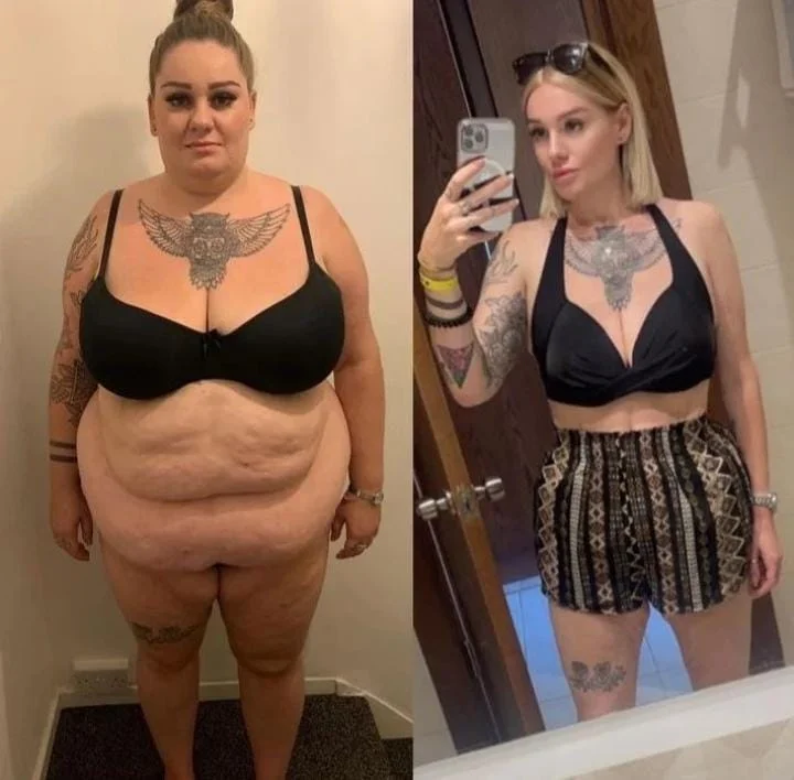Paciente antes e depois da perda de peso