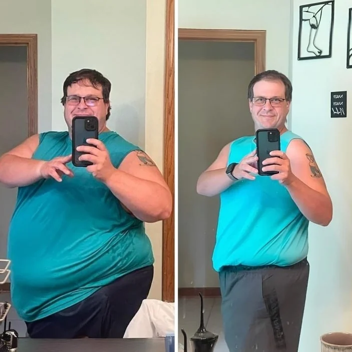 Paciente antes e depois da perda de peso